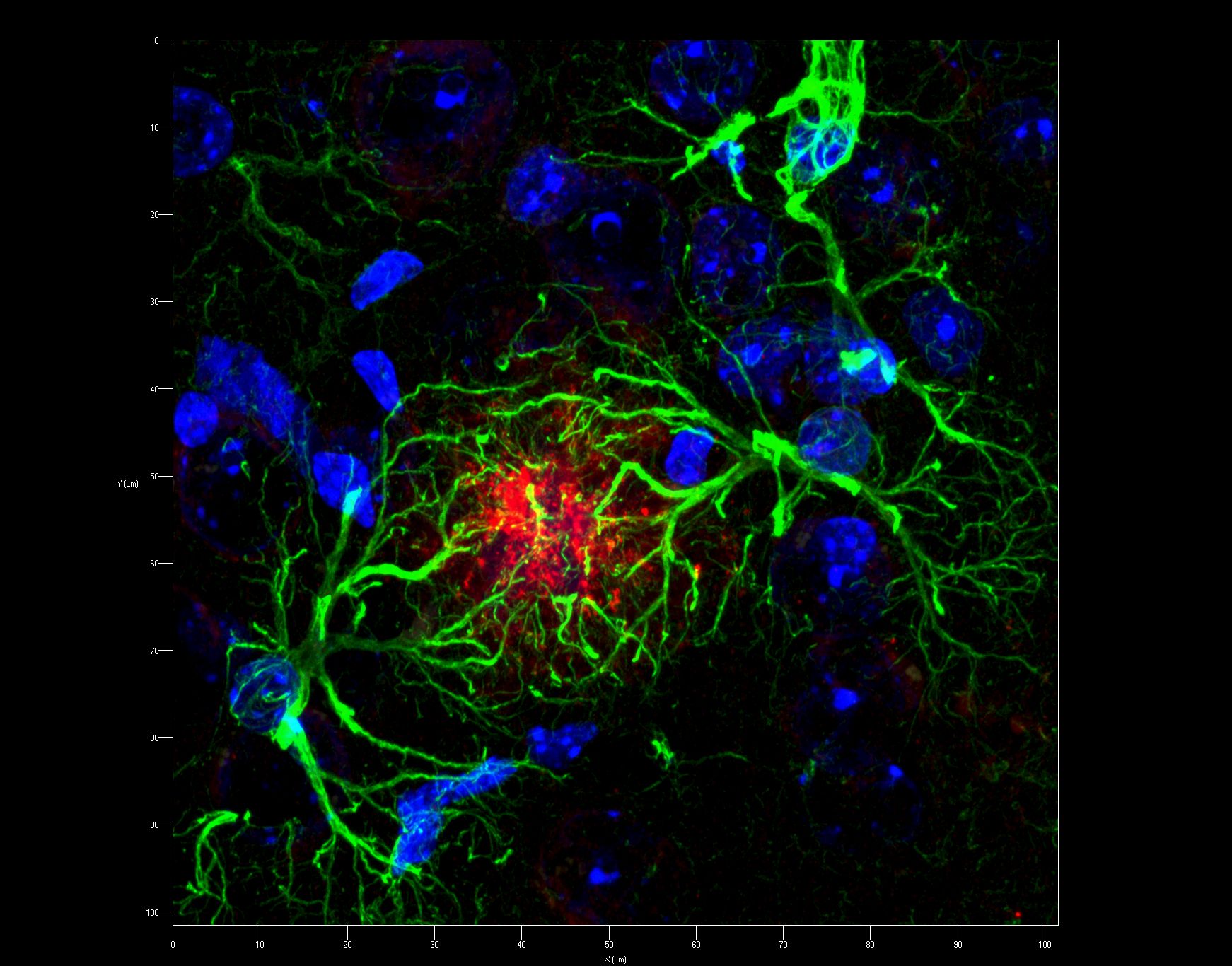 Amyloid in red, surrounding astrocytes in green